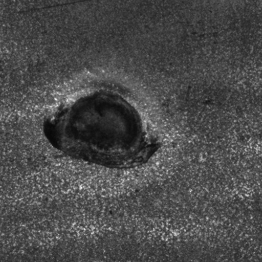 Defeito detectado de uma solda cujo material reteve um formato irregular causando rebarba.